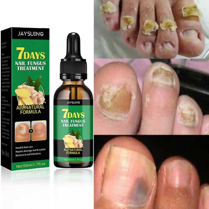 Compra 1 y llevate 2👋🦠Anti Hongos Uñas - 7 Days™ 2UND 30ml