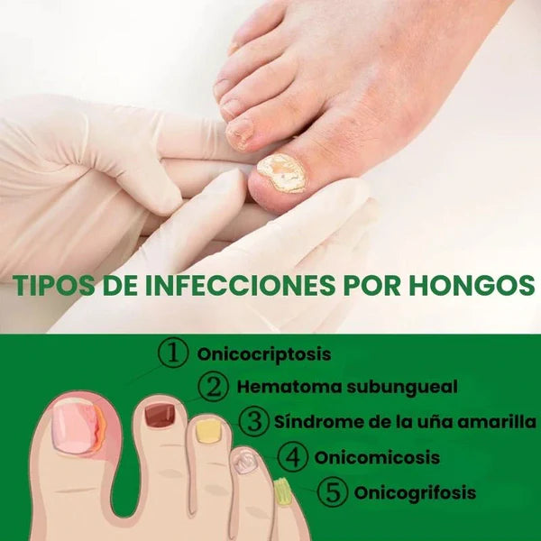 Compra 1 y llevate 2👋🦠Anti Hongos Uñas - 7 Days™ 2UND 30ml
