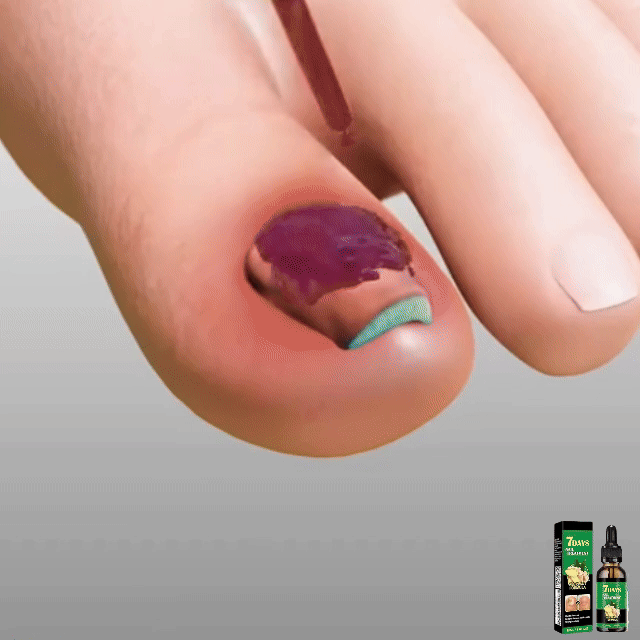 Compra 1 y llevate 2👋🦠Anti Hongos Uñas - 7 Days™ 2UND 30ml