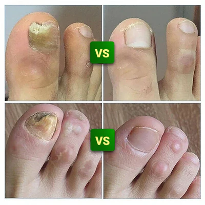 Compra 1 y llevate 2👋🦠Anti Hongos Uñas - 7 Days™ 2UND 30ml