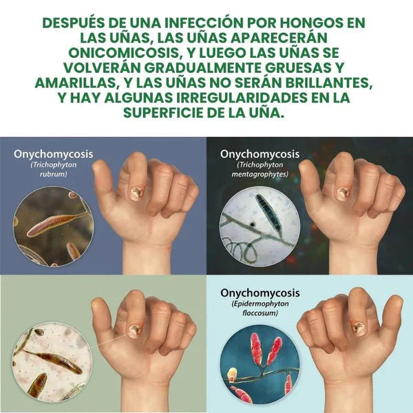 Compra 1 y llevate 2👋🦠Anti Hongos Uñas - 7 Days™ 2UND 30ml