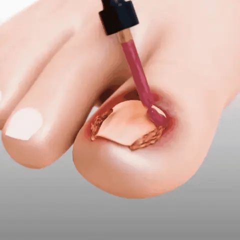 Compra 1 y llevate 2👋🦠Anti Hongos Uñas - 7 Days™ 2UND 30ml